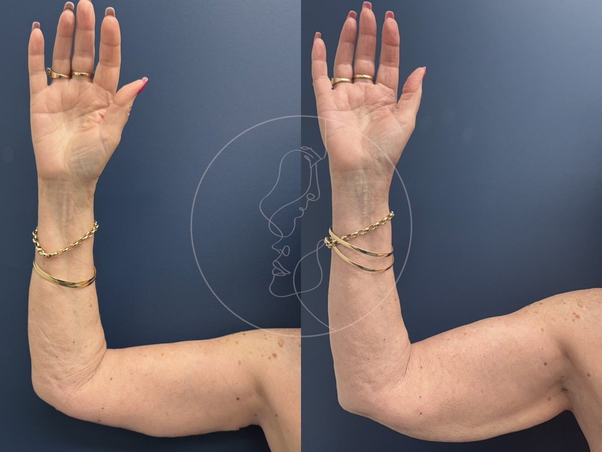 brachioplasty