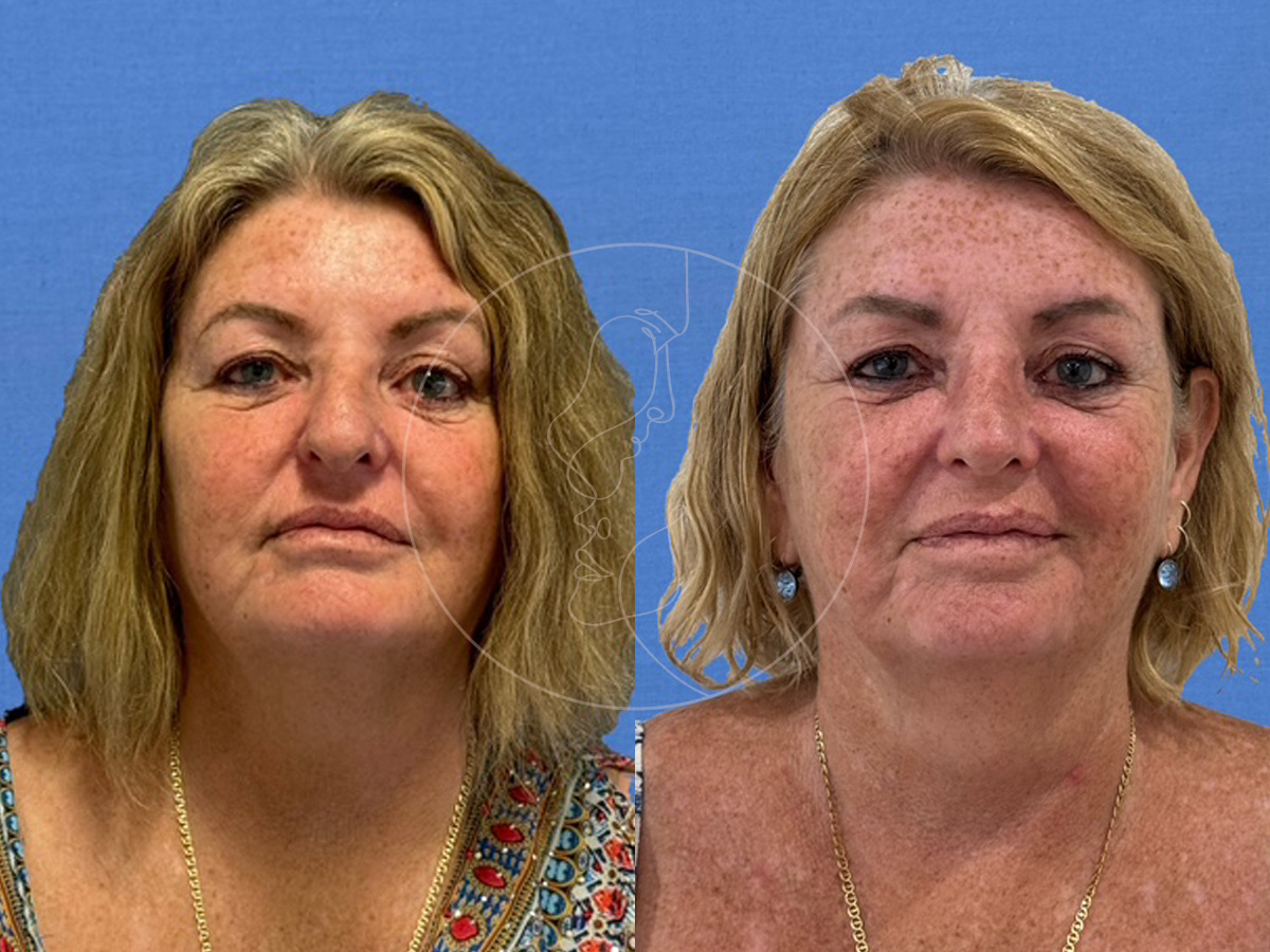 Rhinoplasty | Preservation | Ultrasonic | Liquid