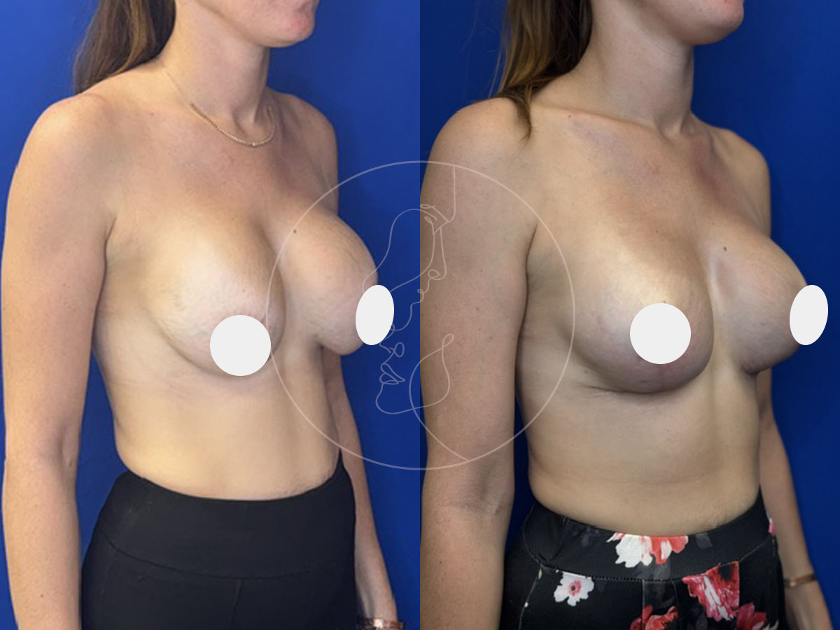 mastopexy-8-26a