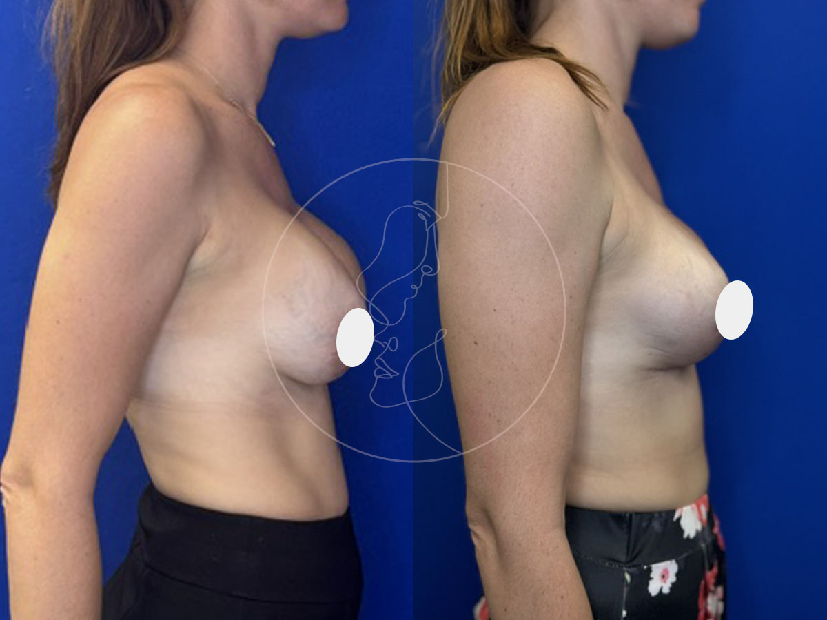 mastopexy-8-26b