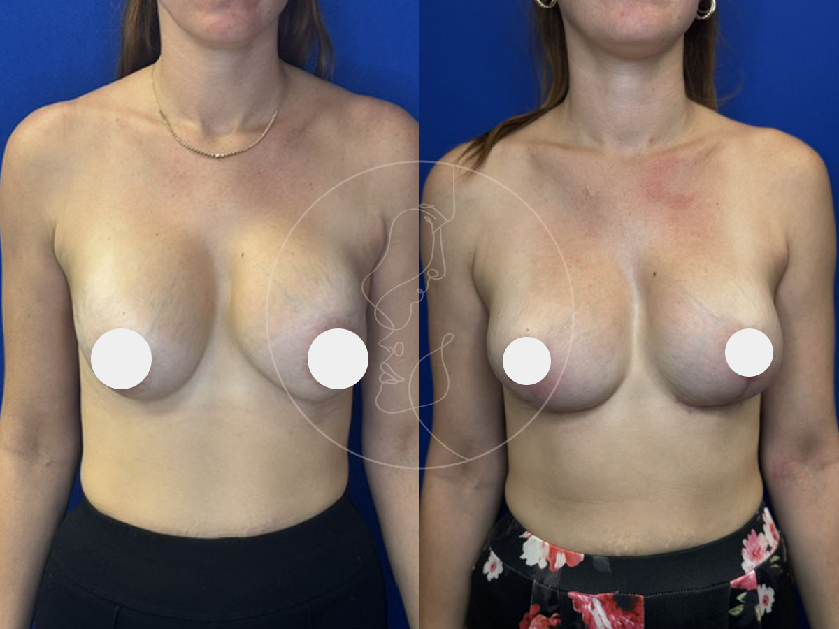 mastopexy-8-26c